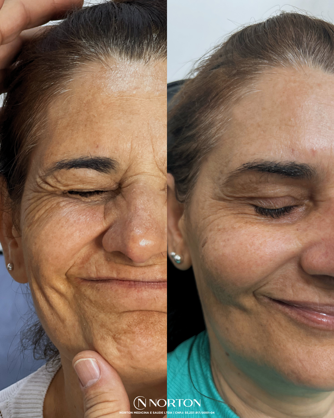 Feed Antes e Depois Glaucinete.zip   4
